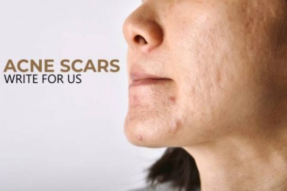 Acne Scars Write for Us, Submit Post, And Advertise with ...